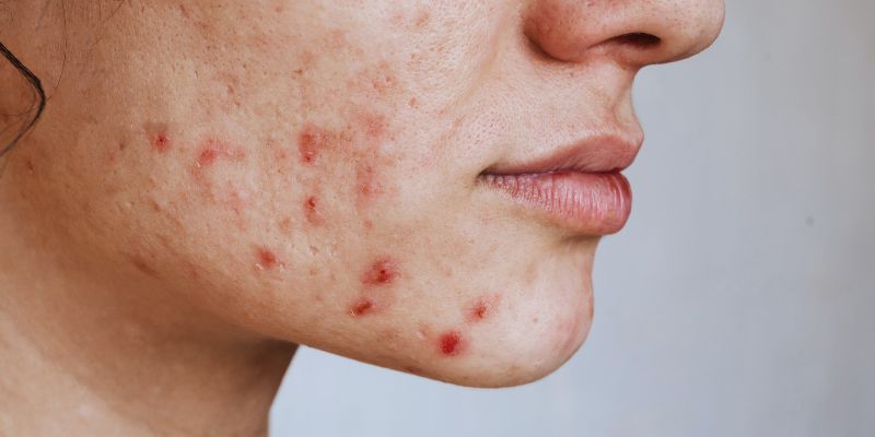 The Ultimate Guide to Laser Treatment for Acne Scars: What You Should Know 